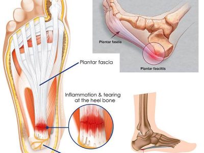 Plantar-fasciitis-1